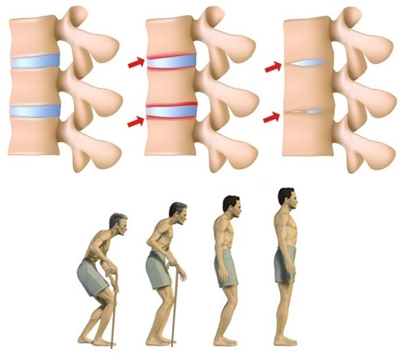 bechterevova choroba nemoc byliny bylinky babske rady caj koupel mast mazani