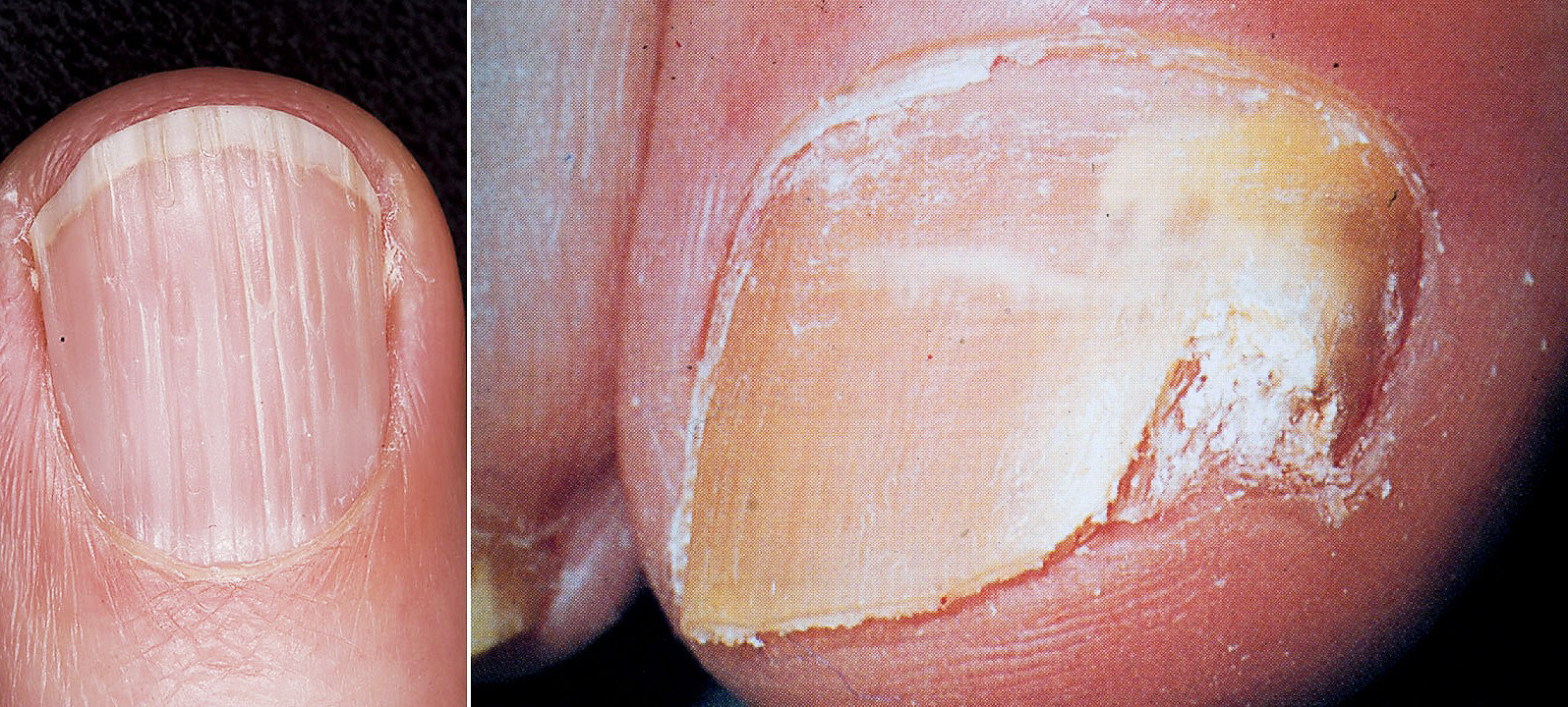 nehty plisen ryhy lamavost byliny bylinky babske rady olej koupel tinktura