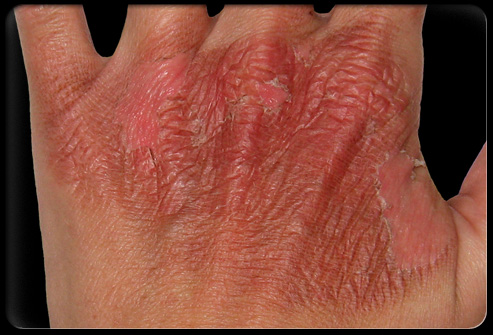 Popálení, popáleniny, spáleniny - byliny, bylinky, babské rady