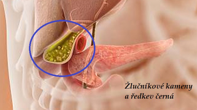 Žlučník, žlučníkové kameny - byliny, bylinky, babské rady